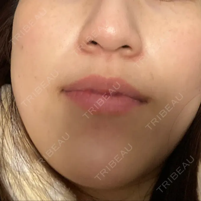 シミ取りレーザー Mavie Beauty Clinic （マヴィービューティークリニック） AFTER メイン用