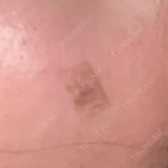 ほくろ・いぼ除去レーザー（肌） リッツ美容外科 大阪院 DAY 5 メイン用