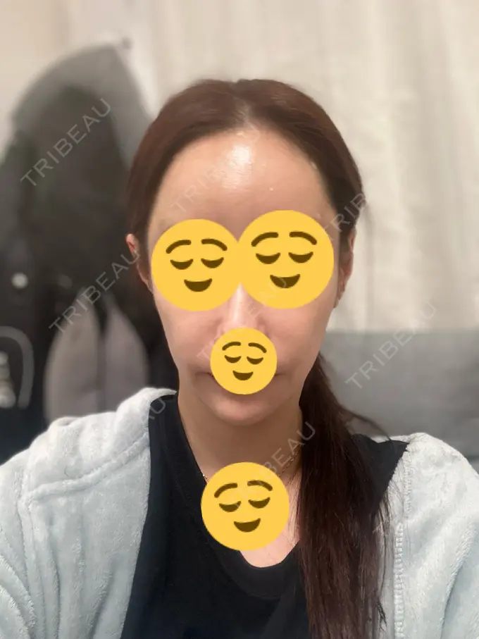 肌ヒアルロン酸注入（たるみ・シワ改善） / ヒアルロン酸注入（額） 豊洲内科・糖尿病 / 形成・美容外科クリニック DAY 2 メイン用