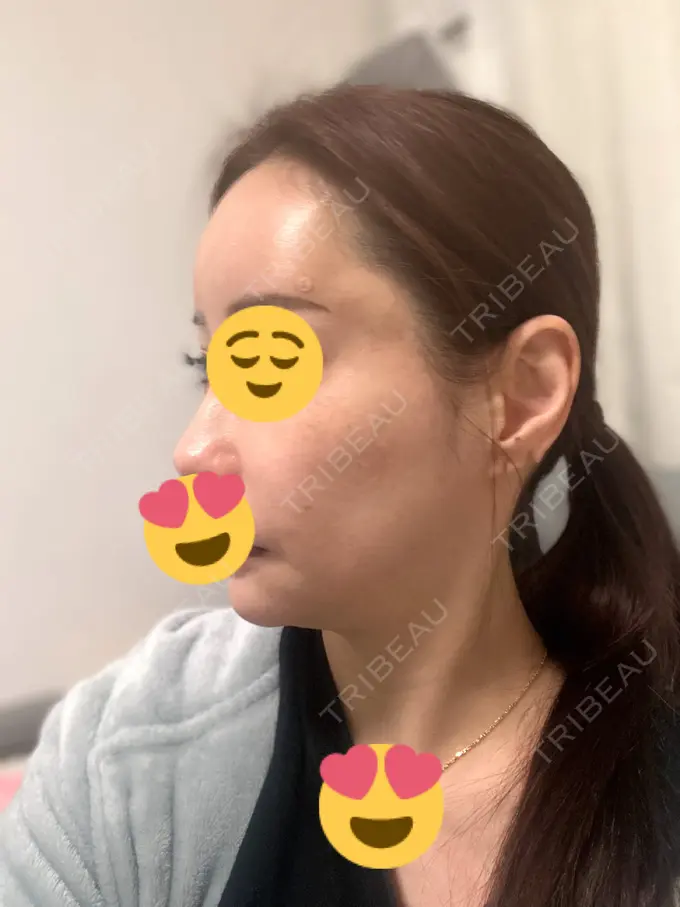 肌ヒアルロン酸注入（たるみ・シワ改善） / ヒアルロン酸注入（額） 豊洲内科・糖尿病 / 形成・美容外科クリニック DAY 2 メイン用