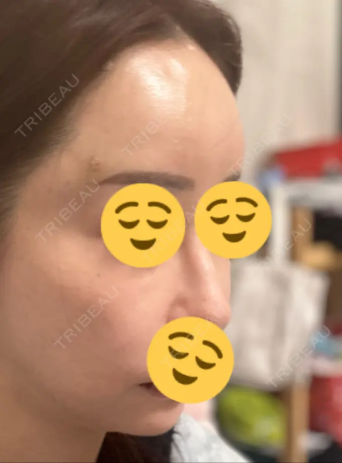 肌ヒアルロン酸注入（たるみ・シワ改善） / ヒアルロン酸注入（額） 豊洲内科・糖尿病 / 形成・美容外科クリニック DAY 2 メイン用