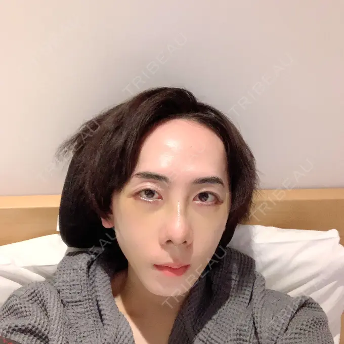 骨切り（あご） / 骨削り（エラ） / 骨削り（頬） id（アイディ）美容外科 DAY 12 メイン用