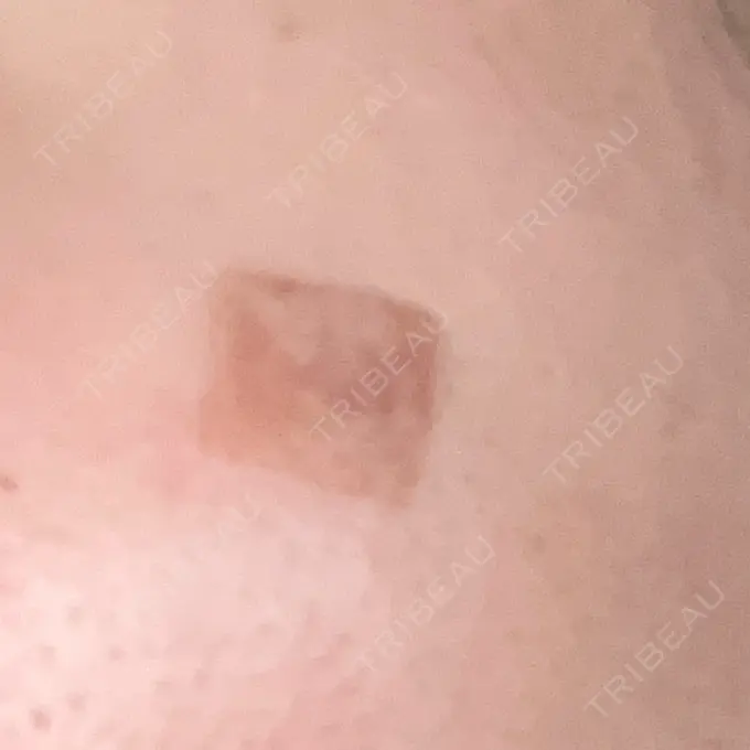 ほくろ・いぼ除去レーザー（肌） リッツ美容外科 大阪院 DAY 6 メイン用