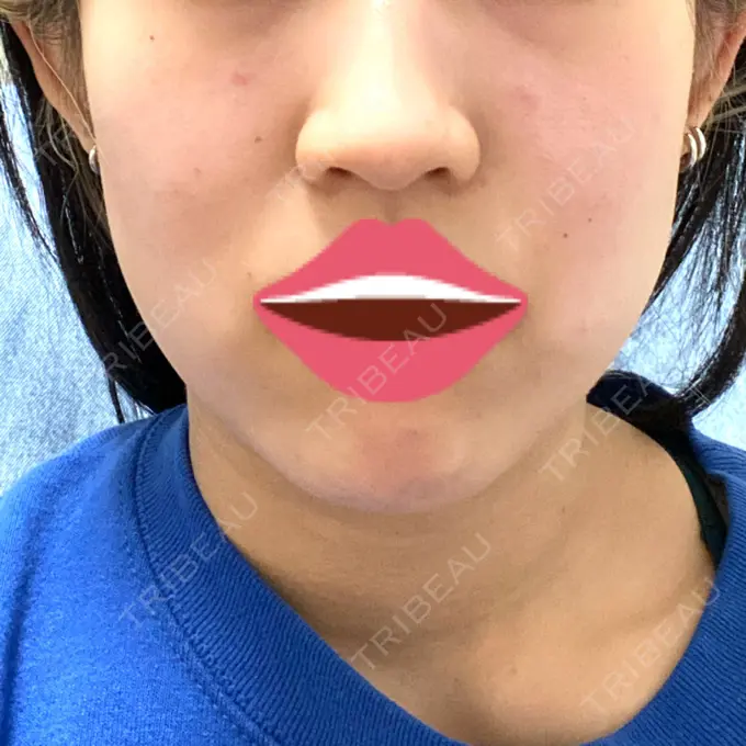 ボトックス（エラ・小顔） ルラ美容クリニック 上野院 DAY 6 メイン用