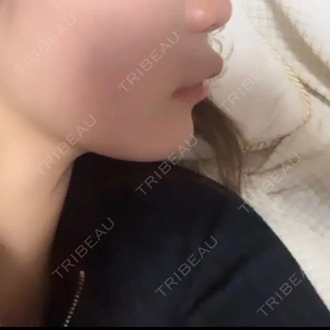 ヒアルロン酸注入（唇） / ボトックス（口角） L‘amour clinic Tokyo【ラムールクリニック東京】 AFTER メイン用