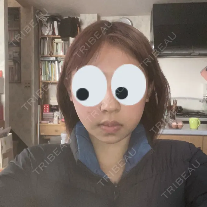 糸リフト / バッカルファット除去 / 脂肪吸引（顔） RIVER CLINIC（リバークリニック） DAY 2 メイン用