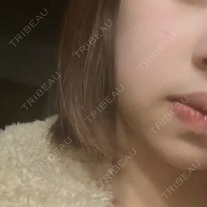 糸リフト / バッカルファット除去 / 脂肪吸引（顔） RIVER CLINIC（リバークリニック） DAY 4 メイン用