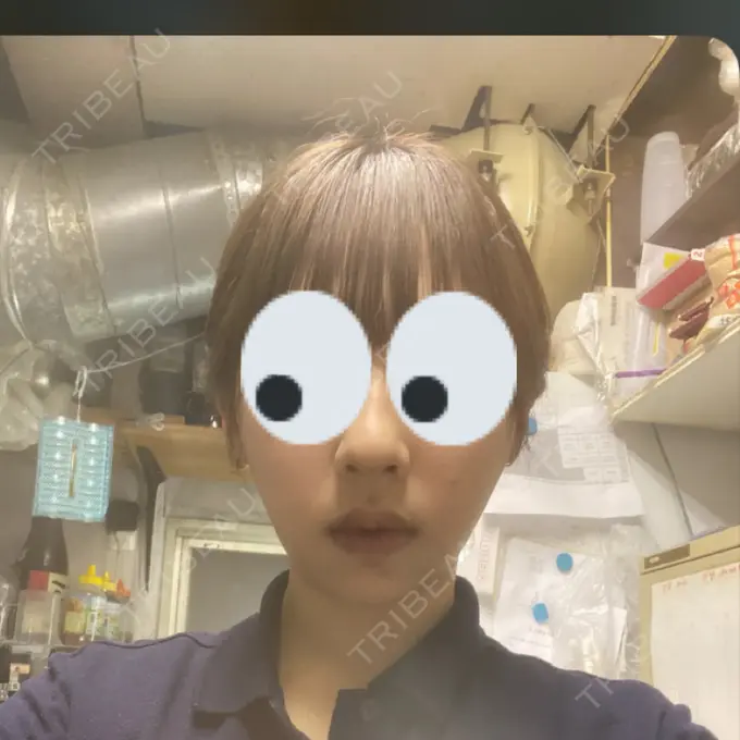 糸リフト / バッカルファット除去 / 脂肪吸引（顔） RIVER CLINIC（リバークリニック） DAY 16 メイン用