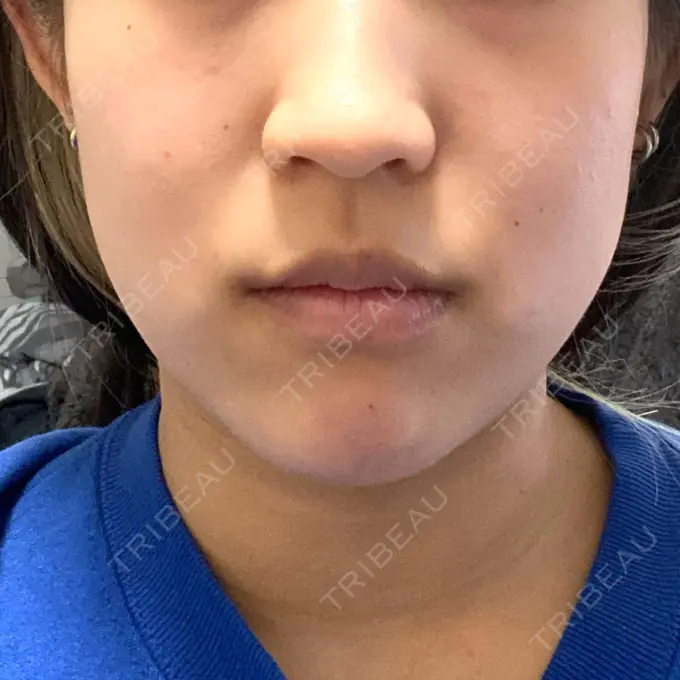 ボトックス（エラ・小顔） ルラ美容クリニック 上野院 DAY 7 メイン用