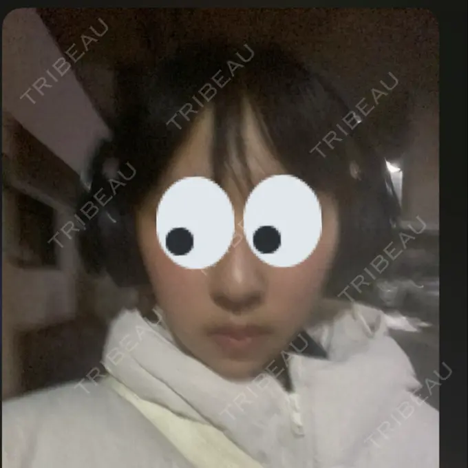 糸リフト / バッカルファット除去 / 脂肪吸引（顔） RIVER CLINIC（リバークリニック） DAY 18 メイン用