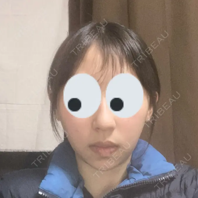 糸リフト / バッカルファット除去 / 脂肪吸引（顔） RIVER CLINIC（リバークリニック） DAY 22 メイン用