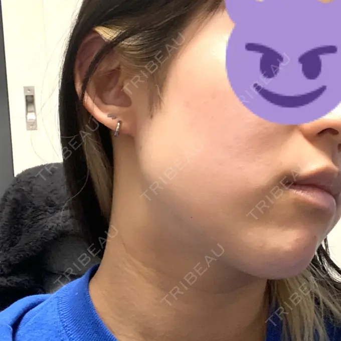 ボトックス（エラ・小顔） ルラ美容クリニック 上野院 DAY 7 メイン用