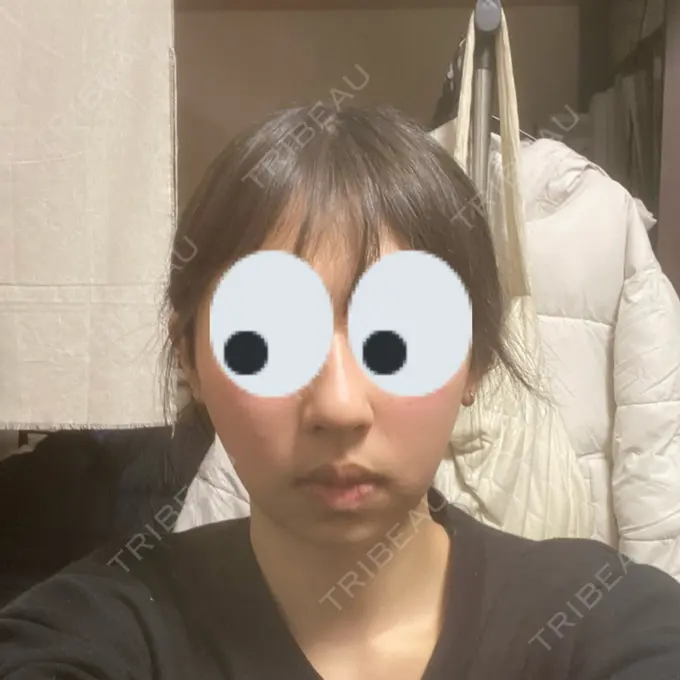 糸リフト / バッカルファット除去 / 脂肪吸引（顔） RIVER CLINIC（リバークリニック） AFTER メイン用