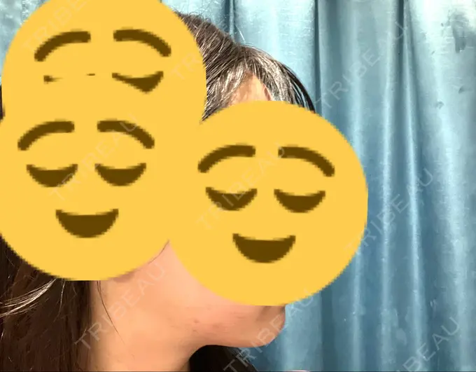 ボトックス（エラ・小顔） / ボトックス（肩） THE FIRST CLINIC 多摩センター院 DAY 9 メイン用