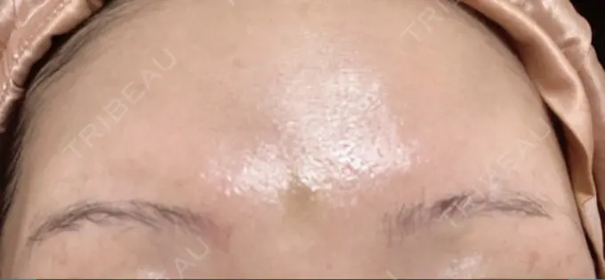 ボトックス（エラ・小顔） / シワ取りボトックス / ボトックス（眉間） / ボトックス（目尻） / ボトックス（額） TCB東京中央美容外科 立川院 AFTER メイン用