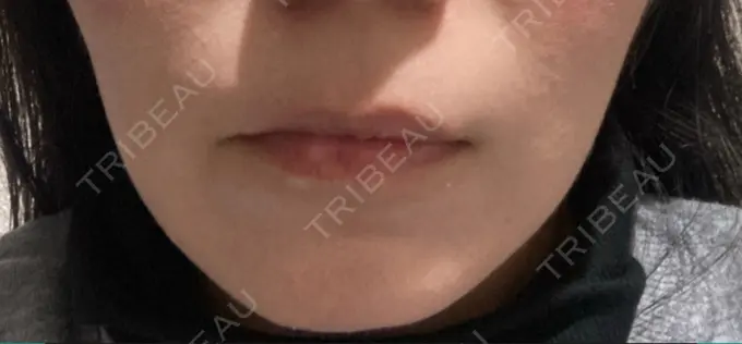 ボトックス（エラ・小顔） / シワ取りボトックス / ボトックス（眉間） / ボトックス（目尻） / ボトックス（額） TCB東京中央美容外科 立川院 DAY 7 メイン用