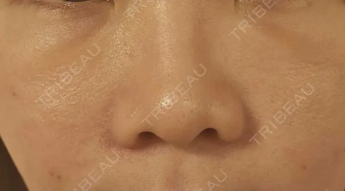 下まぶたの脂肪取り / 脂肪注入（目の下） eクリニック 岡山院 DAY 6 メイン用