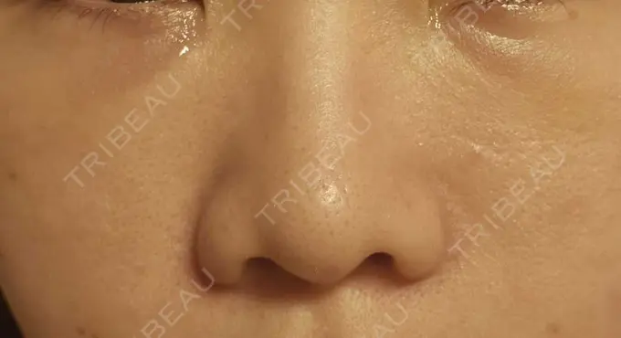 下まぶたの脂肪取り / 脂肪注入（目の下） eクリニック 岡山院 DAY 4 メイン用