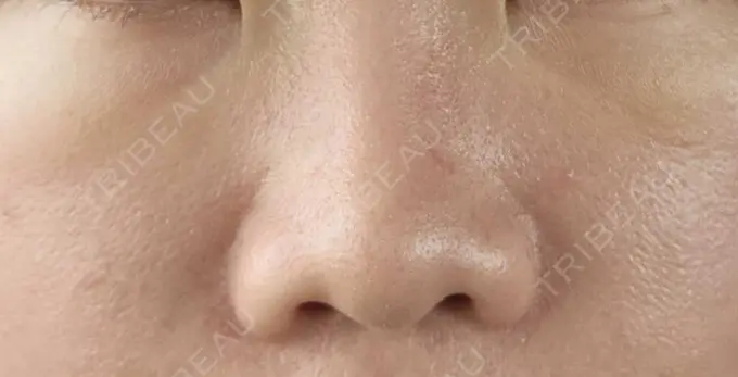 下まぶたの脂肪取り / 脂肪注入（目の下） eクリニック 岡山院 DAY 3 メイン用