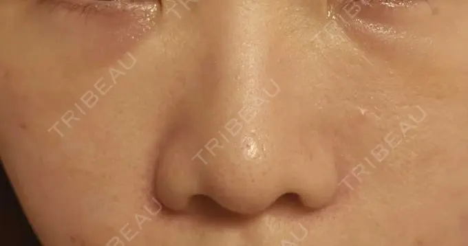 下まぶたの脂肪取り / 脂肪注入（目の下） eクリニック 岡山院 DAY 5 メイン用