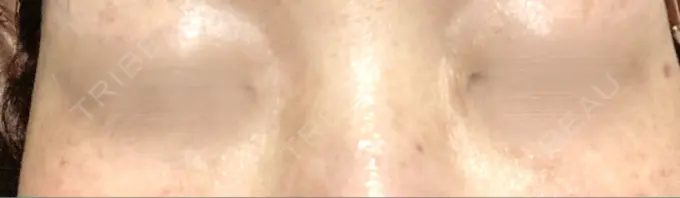 ボトックス（エラ・小顔） / シワ取りボトックス / ボトックス（眉間） / ボトックス（目尻） / ボトックス（額） TCB東京中央美容外科 立川院 DAY 7 メイン用