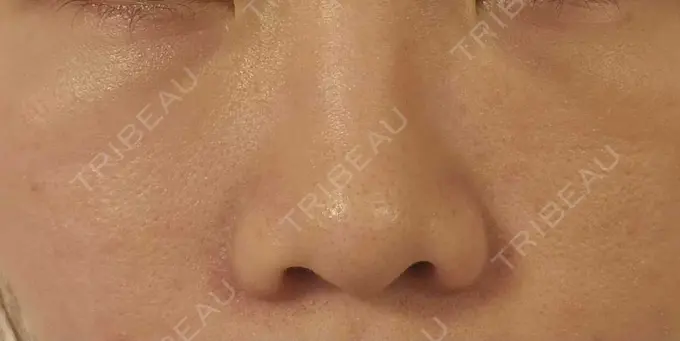 下まぶたの脂肪取り / 脂肪注入（目の下） eクリニック 岡山院 DAY 7 メイン用