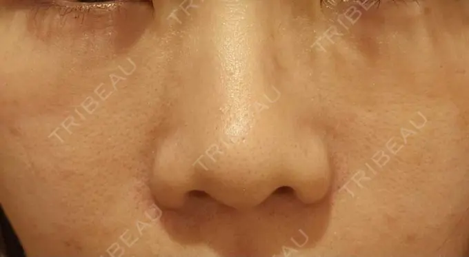 下まぶたの脂肪取り / 脂肪注入（目の下） eクリニック 岡山院 DAY 8 メイン用