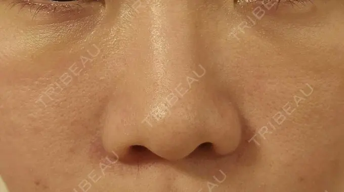 下まぶたの脂肪取り / 脂肪注入（目の下） eクリニック 岡山院 DAY 9 メイン用