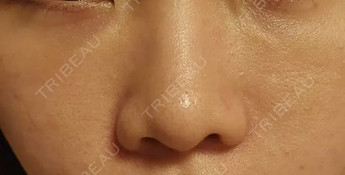 下まぶたの脂肪取り / 脂肪注入（目の下） eクリニック 岡山院 DAY 10 メイン用