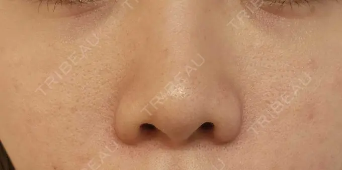 下まぶたの脂肪取り / 脂肪注入（目の下） eクリニック 岡山院 AFTER メイン用