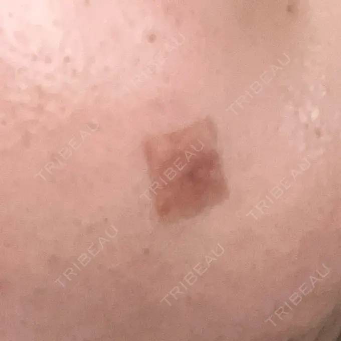 ほくろ・いぼ除去レーザー（肌） リッツ美容外科 大阪院 DAY 8 メイン用