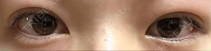 二重埋没 湘南美容クリニック 京都院 AFTER メイン用