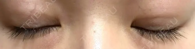 二重埋没 湘南美容クリニック 京都院 DAY 29 メイン用