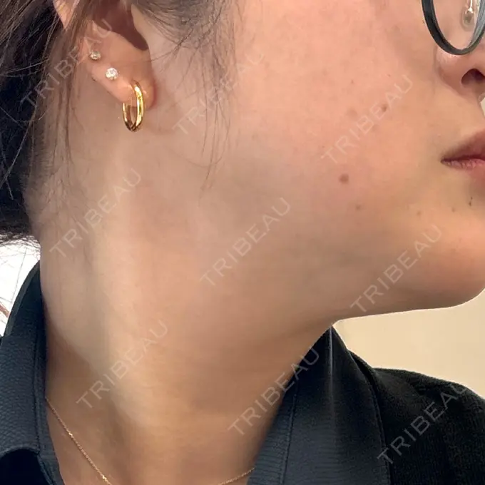 ボトックス（エラ・小顔） / 美容点滴・美容注射（ダイエット） / ハイフ（顔） S-Laboクリニック 渋谷院 AFTER メイン用