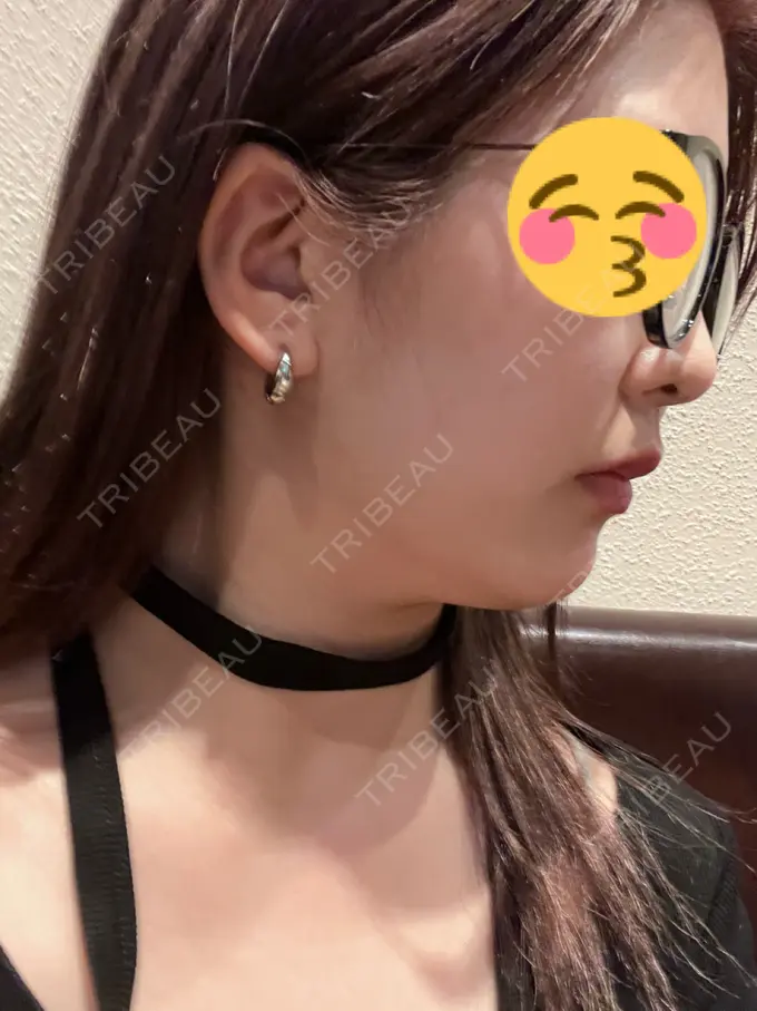 ハイフ（顔） Mavie Beauty Clinic （マヴィービューティークリニック） DAY 0 メイン用