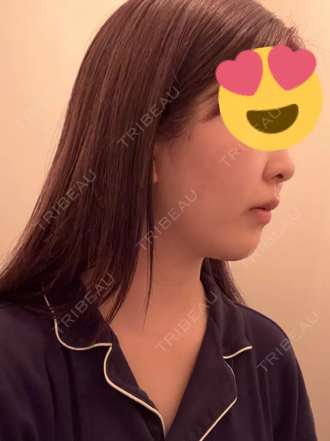 ハイフ（顔） Mavie Beauty Clinic （マヴィービューティークリニック） DAY 0 メイン用