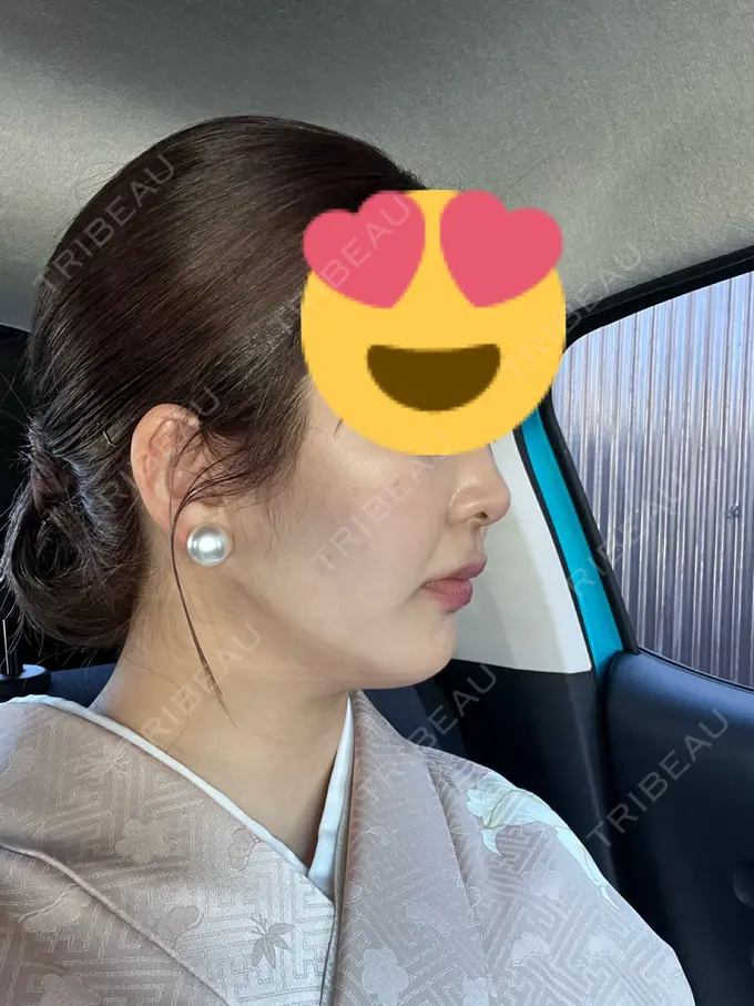 ハイフ（顔） Mavie Beauty Clinic （マヴィービューティークリニック） DAY 1 メイン用