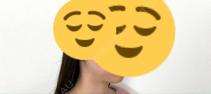 ボトックス（エラ・小顔） / ボトックス（肩） THE FIRST CLINIC 多摩センター院 DAY 10 メイン用