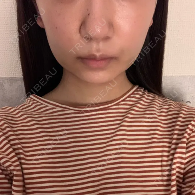 糸リフト / バッカルファット除去 / 脂肪吸引（顔） RIVER CLINIC（リバークリニック） DAY 4 メイン用