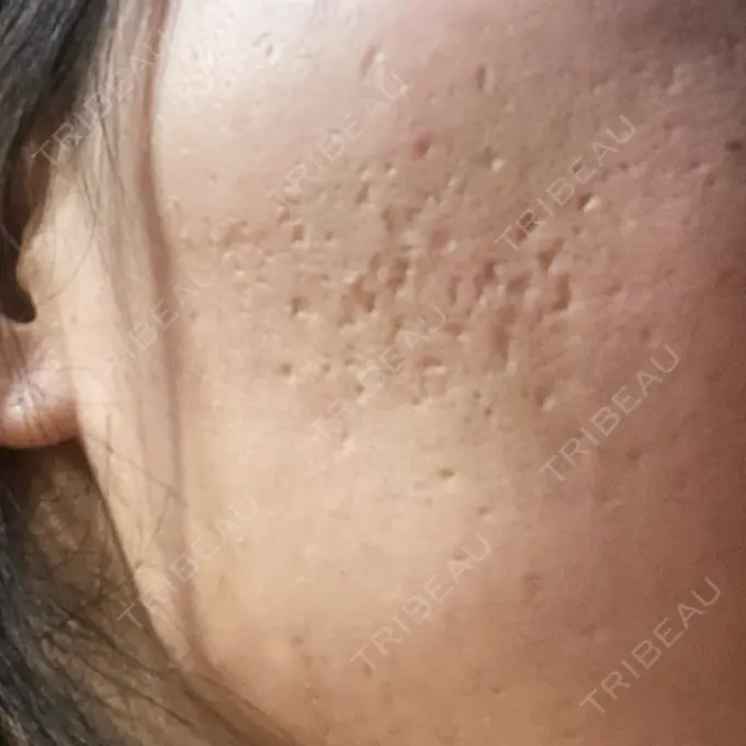 ヒアルロン酸注入（頬） / その他（肌） ゆきスキンクリニック 東池袋 AFTER メイン用