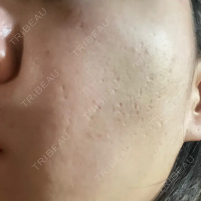 ヒアルロン酸注入（頬） / その他（肌） ゆきスキンクリニック 東池袋 DAY 10 メイン用