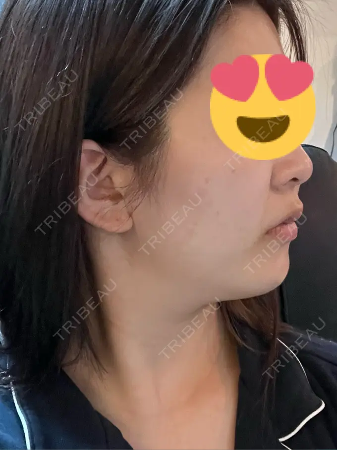 ハイフ（顔） Mavie Beauty Clinic （マヴィービューティークリニック） DAY 3 メイン用