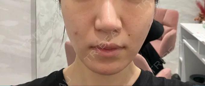 糸リフト Pono clinic 【ポノクリ】 AFTER メイン用