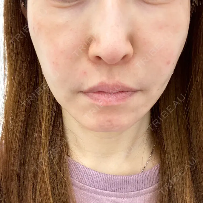 糸リフト / 肌ヒアルロン酸注入（たるみ・シワ改善） TCB東京中央美容外科 宇都宮院 AFTER メイン用