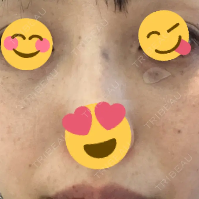 ルビーレーザー S-Laboクリニック 渋谷院 DAY 5 メイン用