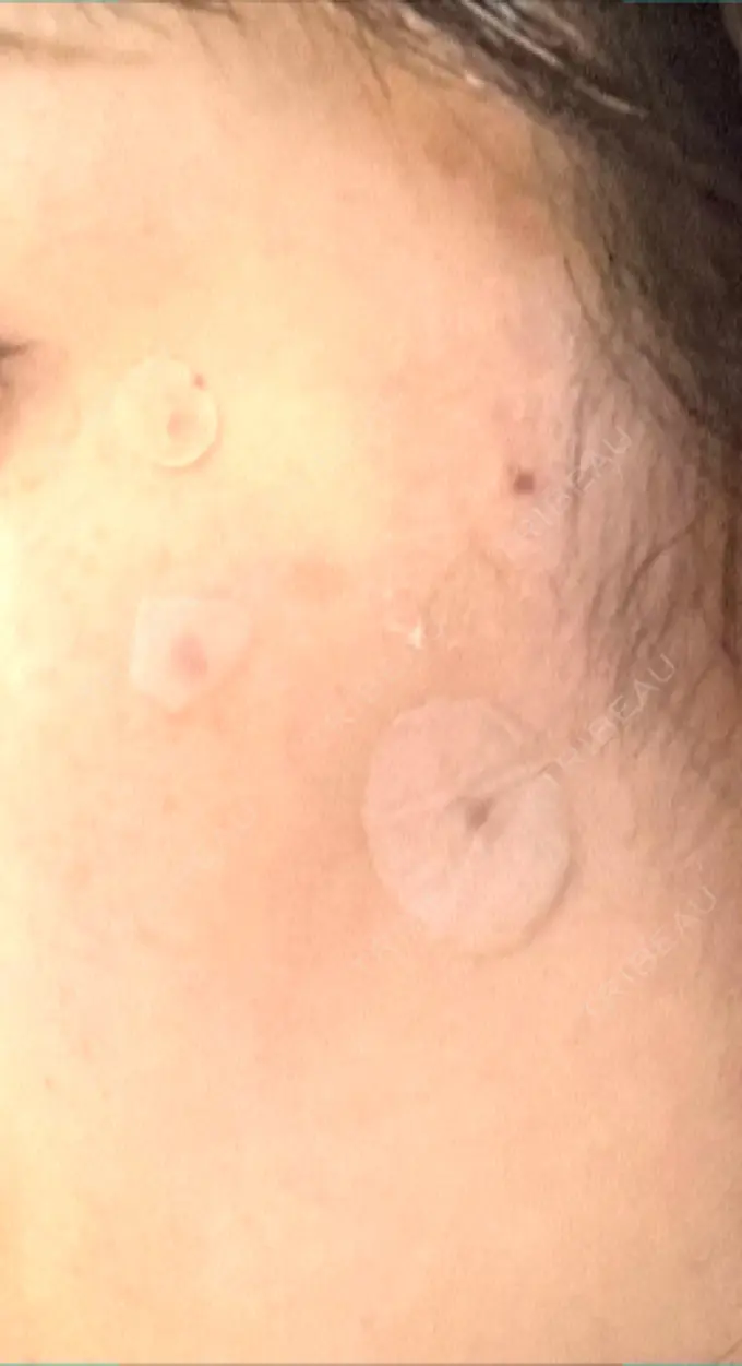 ルビーレーザー S-Laboクリニック 渋谷院 DAY 5 メイン用