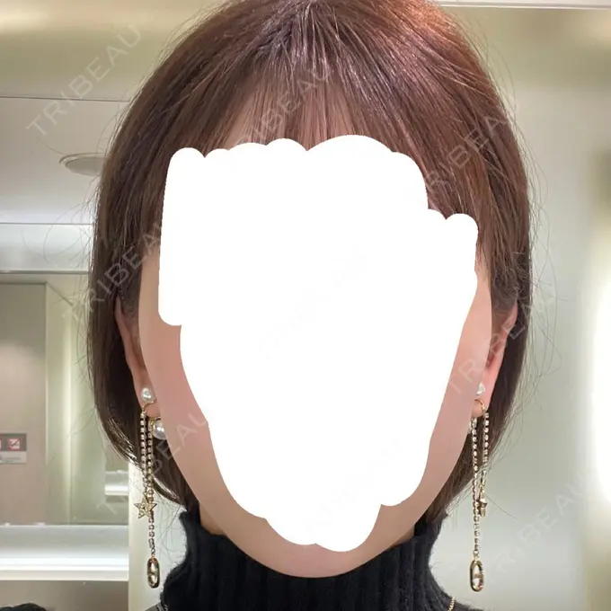 脂肪吸引（顔） Mods Clinic（モッズクリニック） 名古屋院 DAY 30 メイン用