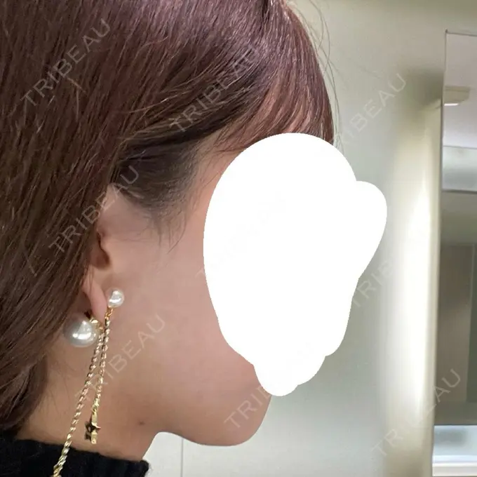 脂肪吸引（顔） Mods Clinic（モッズクリニック） 名古屋院 DAY 30 メイン用