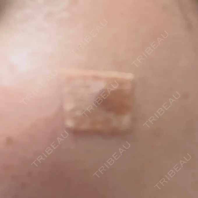 ほくろ・いぼ除去レーザー（肌） リッツ美容外科 大阪院 DAY 9 メイン用