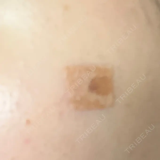 ほくろ・いぼ除去レーザー（肌） リッツ美容外科 大阪院 DAY 10 メイン用